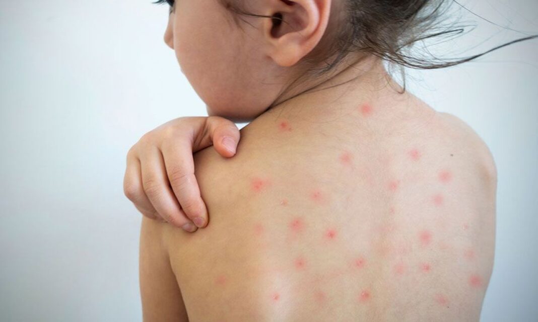 Salvați Copiii: România, responsabilă pentru 75% din cazurile de rujeolă din UE. „Orice copil nevaccinat riscă să se îmbolnăvească sau să moară”